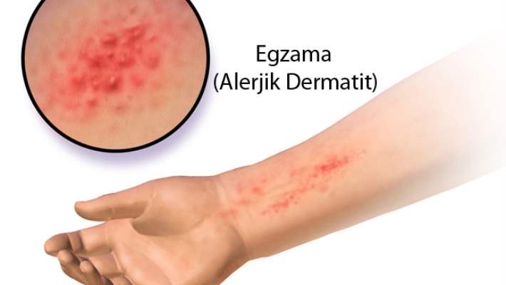 Dermatit  (Deri İltihabı)