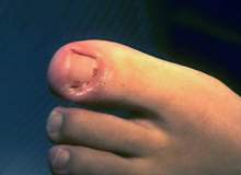 Tırnak Altı Kanama Tırnak Altı Kanama