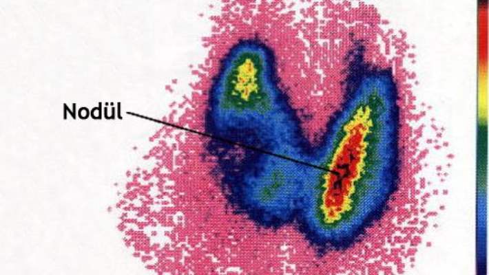 Tiroit Nodülleri