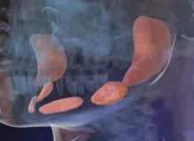 Tükürük Kanalı Tıkanması Tükürük Kanalı Tıkanması