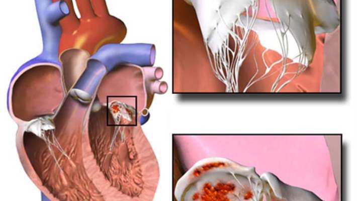 Endokardit (Kalp İç Zarı İltihabı)
