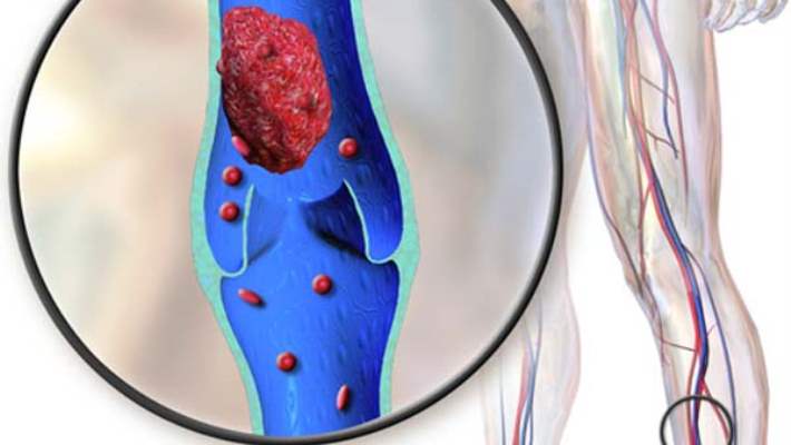 Derin Damar Trombozu