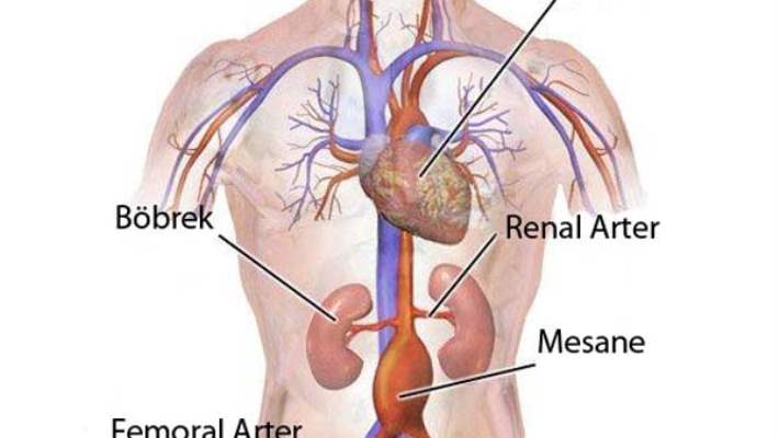 aort anevrizmasi karin hemen saglik