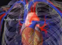 Aort Yırtılması (Diseksiyon) Aort Yırtılması (Diseksiyon)