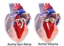 Aortik Kapak Regürjitasyonu Aortik Kapak Regürjitasyonu