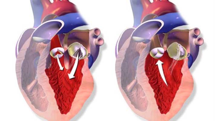 Aortik Kapak Regürjitasyonu