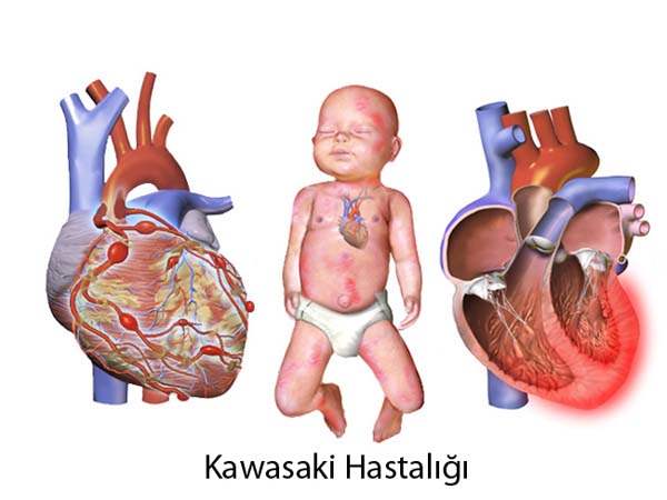 Kawasaki Hastalığı
