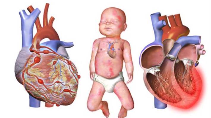 Kawasaki Hastalığı