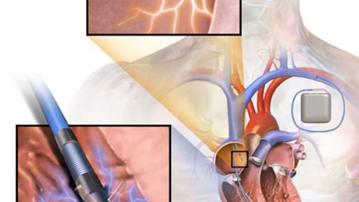 Kalp Yetmezliginde Kalp Pili Taktirmaliyi Miyim Hemen Saglik