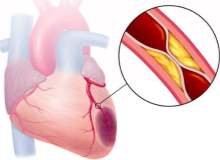 Atrial Çarpıntı ve Atrial Çırpınım