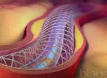 Anjiyoplasti Anjiyoplasti