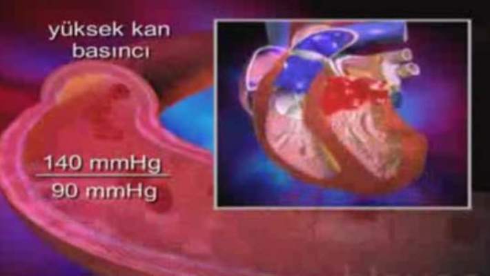 Yüksek Tansiyon (Yüksek Kan Basıncı)