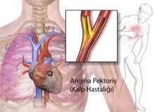 Kalp Hastalığı ve Angina (Göğüs Ağrısı) Kalp Hastalığı ve Angina (Göğüs Ağrısı)