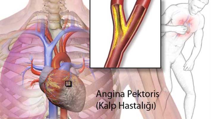 Kalp Hastalığı Ve Angina (Göğüs Ağrısı)