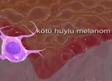 Melanom Melanom