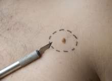 Benleri Aldırmak ve  Melanom Riskini Azaltır Benleri Aldırmak ve  Melanom Riskini Azaltır