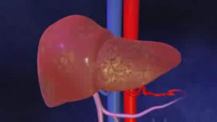 Karaciğerin Bir Kısmının Alınması (Reseksiyon)