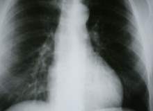 KOAH la Yaşamak KOAH la Yaşamak