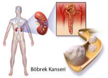 Böbrek Kanseri Böbrek Kanseri