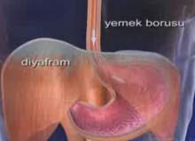 Yemek Borusu Kanseri