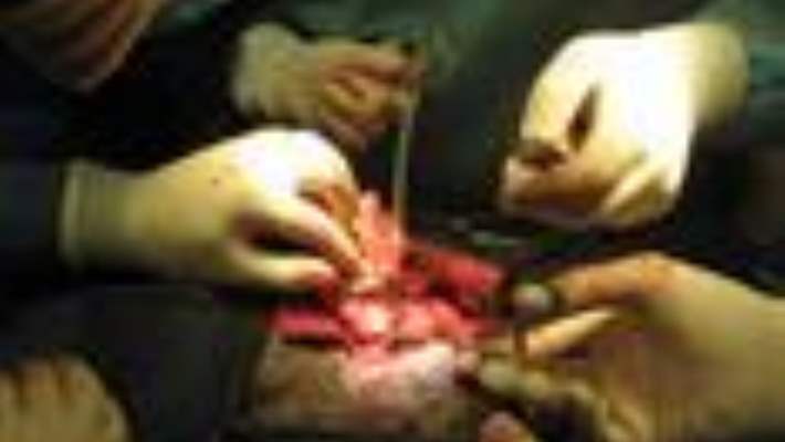 Akciğer Nakli Nedir?