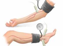 Ayak Bileği-Kol İndeks (ACI) Ayak Bileği-Kol İndeks (ACI)