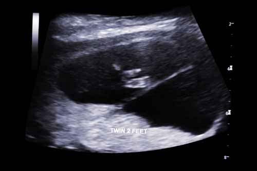 Birinci Trimester Tarama
