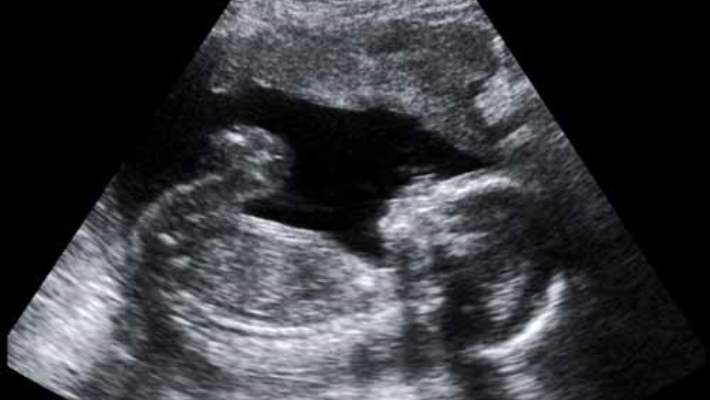 Fetal Ultrason