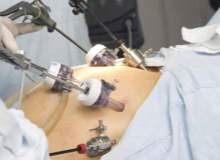 Gastrik Baypas Ameliyatı Gastrik Baypas Ameliyatı