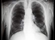 Akciğer Embolisi Nasıl Teşhis Edilir?