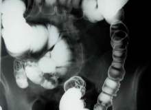 Kolonoskopi Kolonoskopi