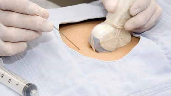 Koryonik Villus Örneklemesi