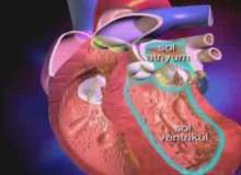 Sol Ventrikül Destek Cihazı (VDC) Sol Ventrikül Destek Cihazı (VDC)