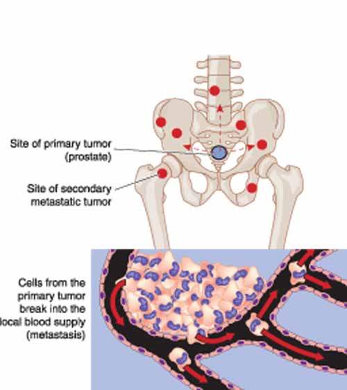 Açık Prostat Alımı Ameliyatı (Prostatektomi)