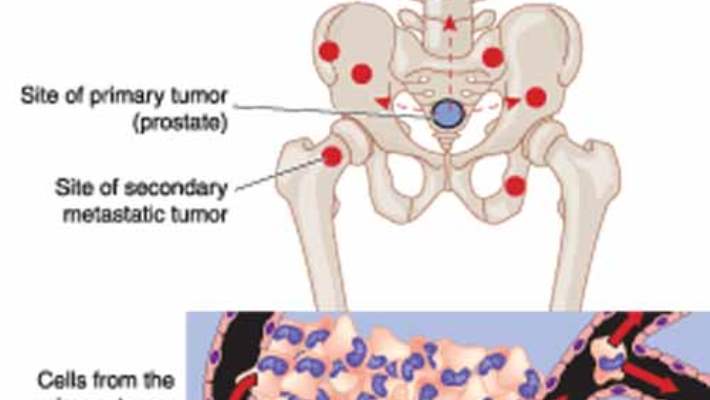 Açık Prostat Alımı Ameliyatı (Prostatektomi)