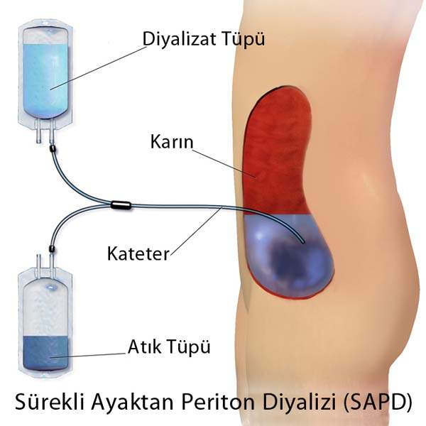 Peritoneal Diyaliz