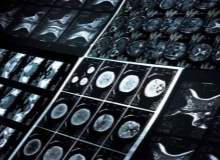 SPECT tarama SPECT tarama