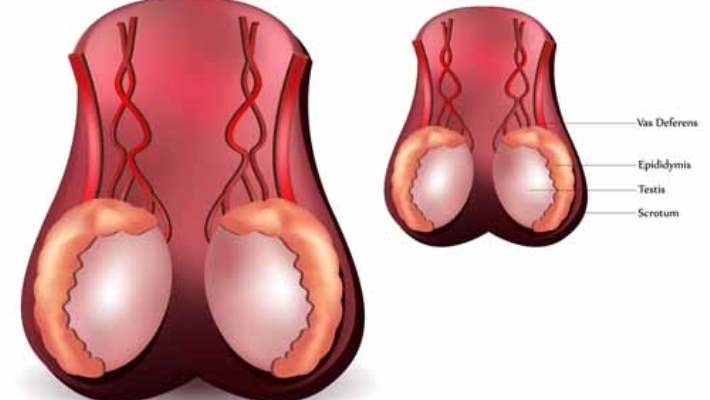 Vazektomi Sonrası Geri Dönüşüm Ameliyatı