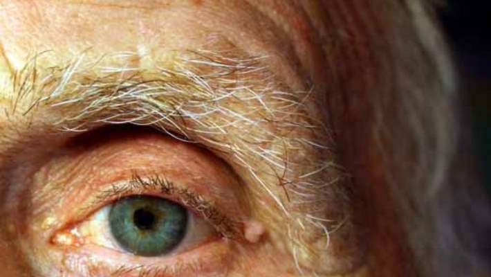 Diyabetik Göz Hastalığı (Retinopati)