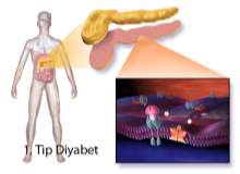 1. Tip Diyabet 1. Tip Diyabet
