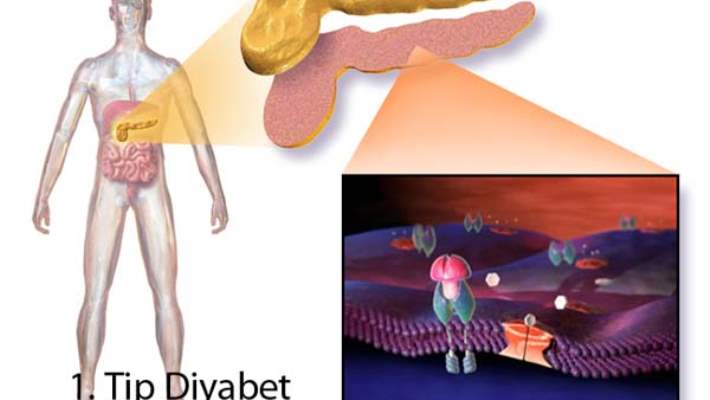 1. Tip Diyabet