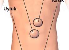 Göbek Fıtığı (Umblikal Herni) Göbek Fıtığı (Umblikal Herni)