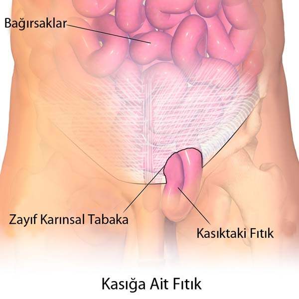 Kasık Fıtığı