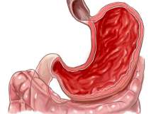 Mide İltihabı Mide İltihabı