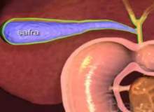 Safra Taşlarını Düşürmek İçin Ne Yapılmalı? Safra Taşlarını Düşürmek İçin Ne Yapılmalı?