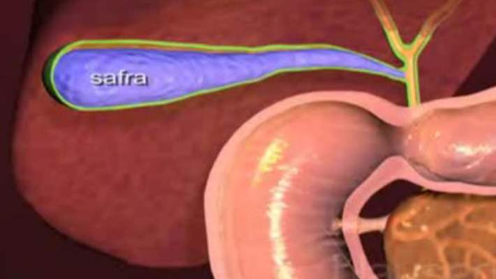 Safra Taşlarını Düşürmek İçin Ne Yapılmalı?