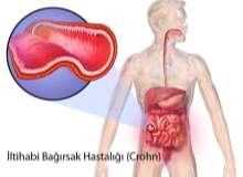 Crohn hastalığı Crohn hastalığı