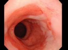 Yemek Borusu Daralması Yemek Borusu Daralması