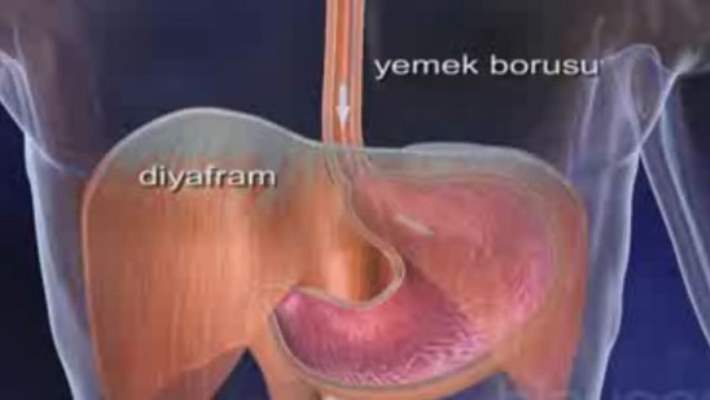 Yemek Borusu Krampları