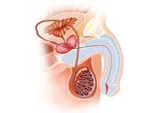 Peyronie Hastalığı Peyronie Hastalığı